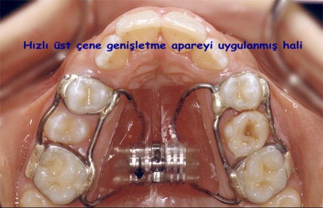 H�zl� �st �ene geni�letme apareyi