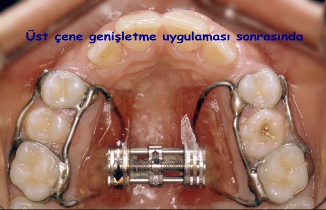 H�zl� �st �ene geni�letmesi uygulamas�ndan sonraki g�r�n�m