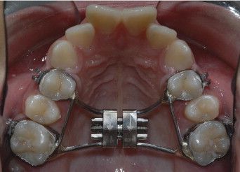 Hyrax Geni�letme Apareyi