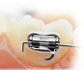 smart clip braketler