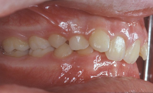 derin �rt�l� kapan��