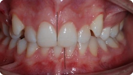 orta hat uyumsuzlu�u