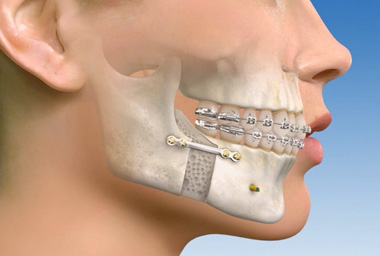 ortognatik cerrahi 5