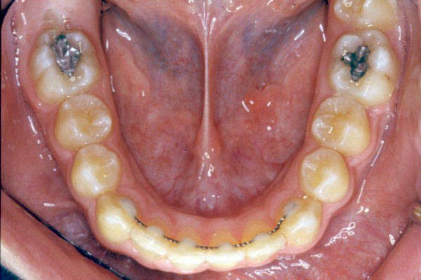 alt pekiştirme apareyi